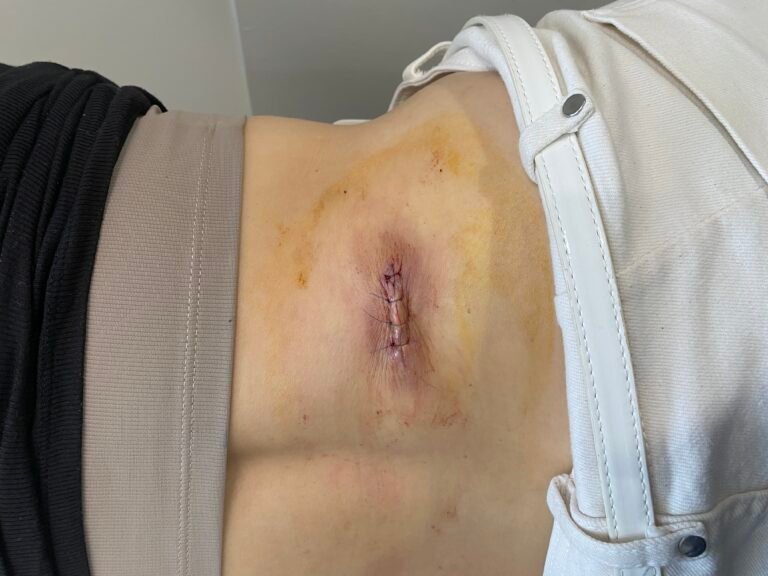 infected cyst back larger scar