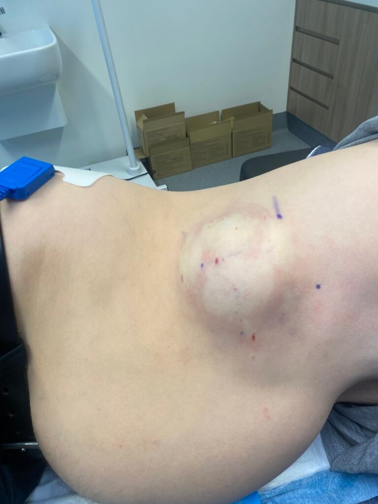large lipoma lateral chest