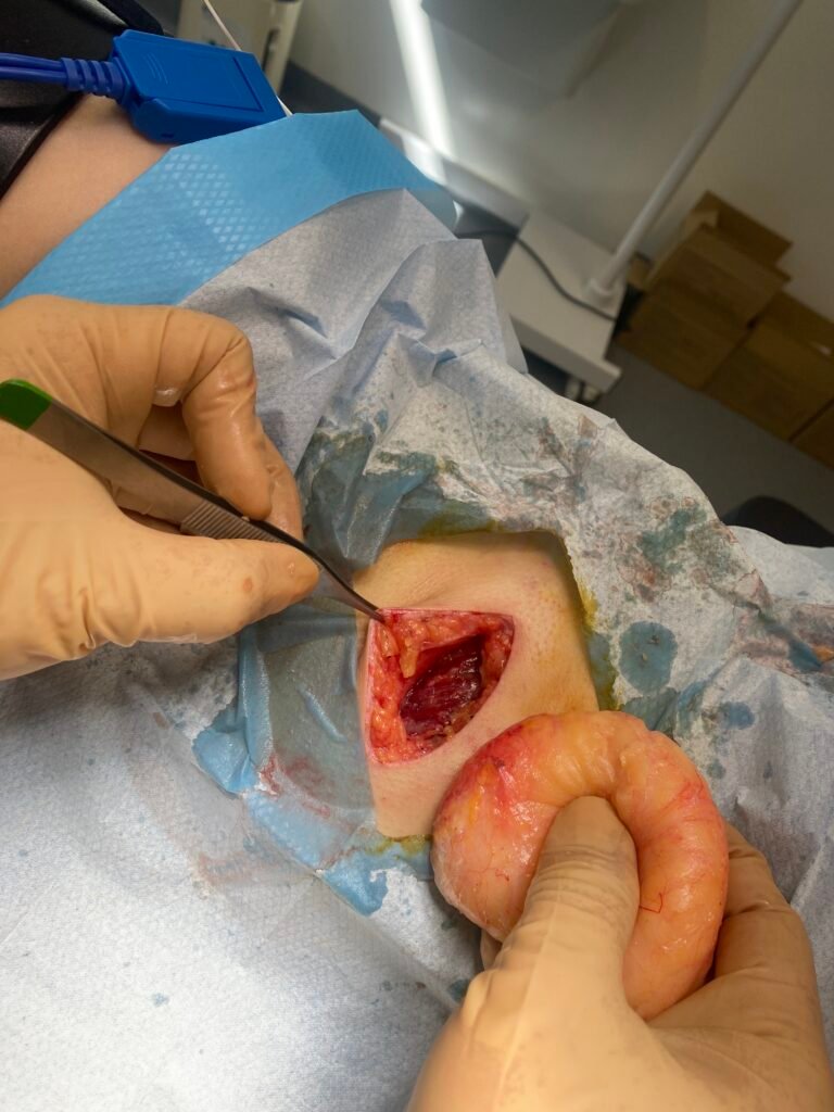large lipoma lateral chest removed