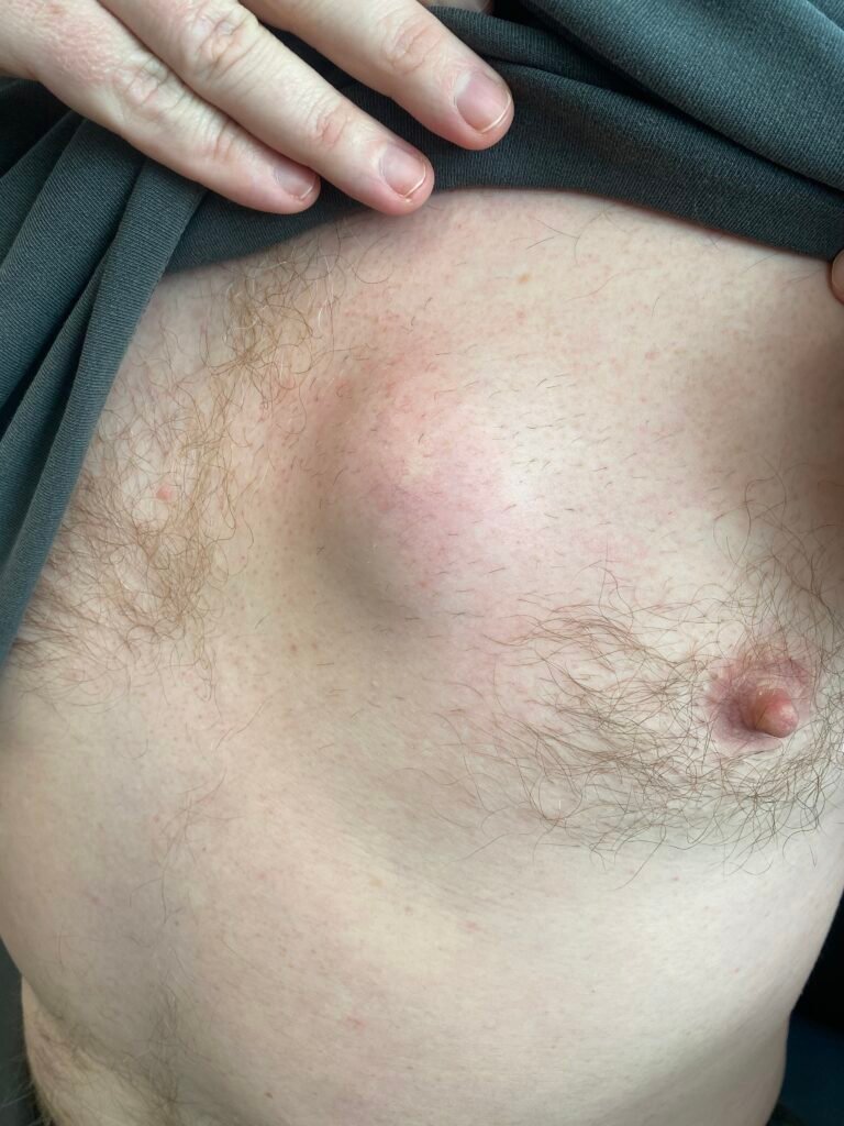 large cyst chest