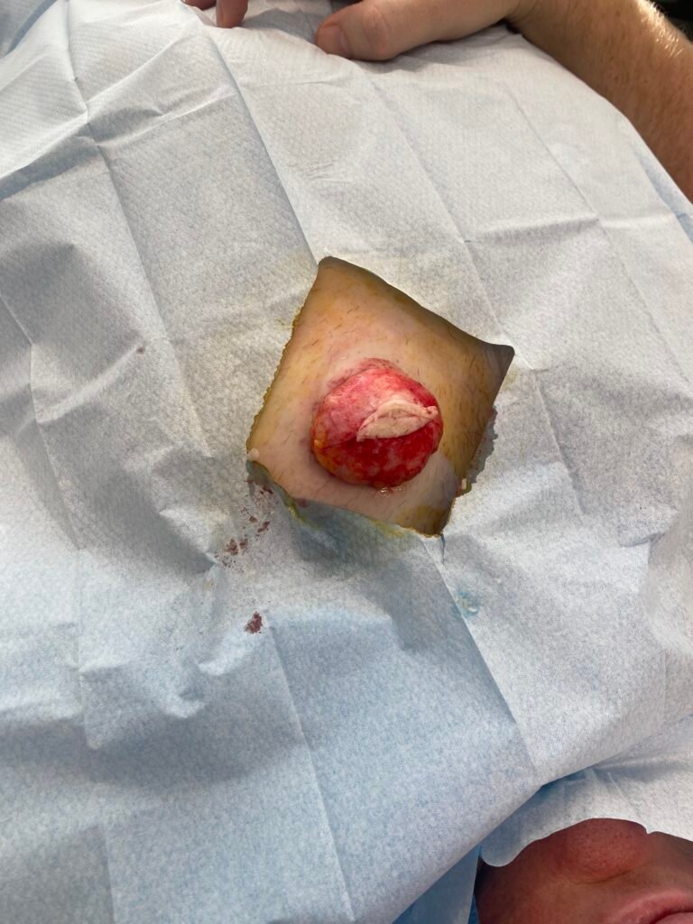 cyst dissected out
