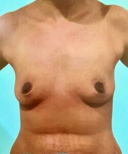 breast augmentation 1