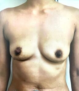 breast augmentation before