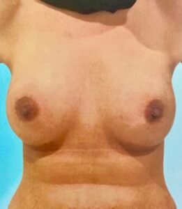 breast augmentation 3