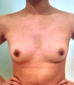 breast augmentation 10