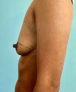breast augmentation before lateral