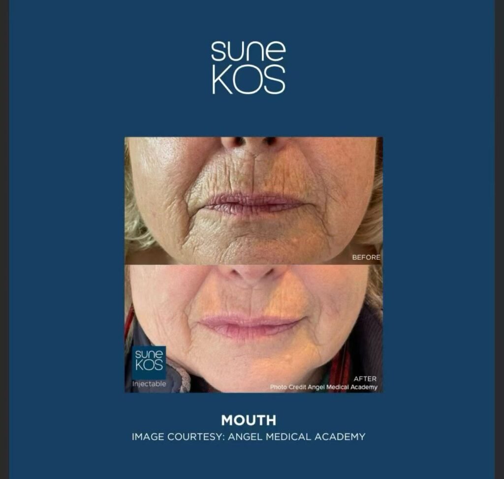 Sune Kos 2