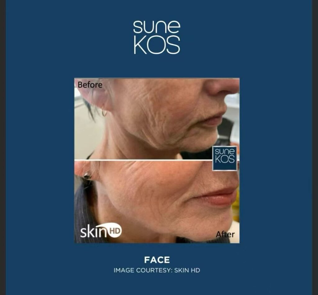 Sune Kos 4