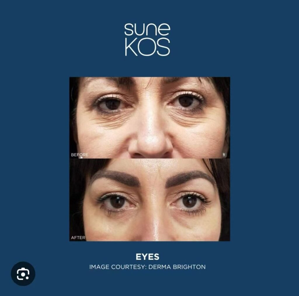 Sune Kos 3