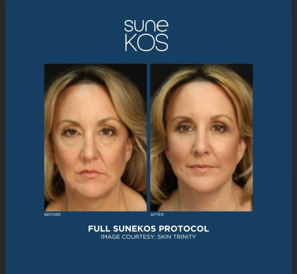 sune Kos 6